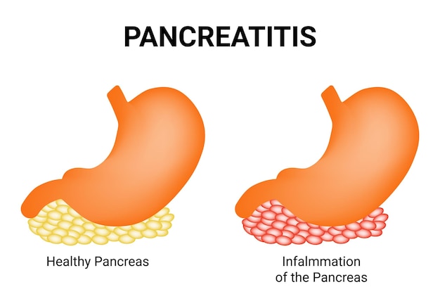 pancreatitis healthy pancreas information of the pancrease vector illustration